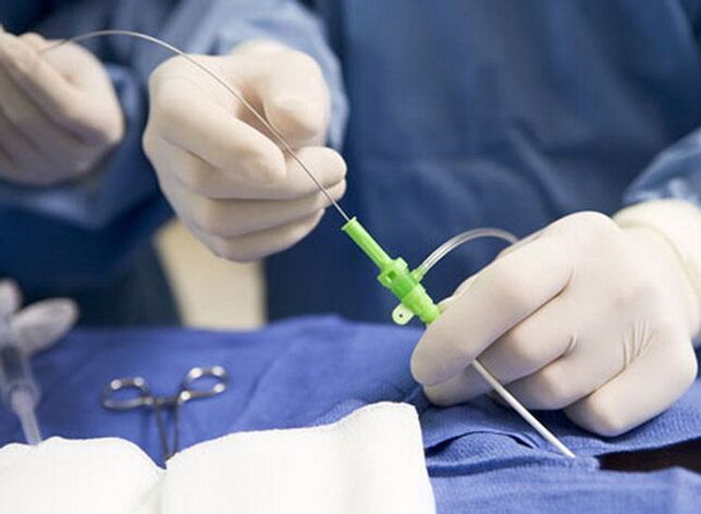 Радиочестотна аблация