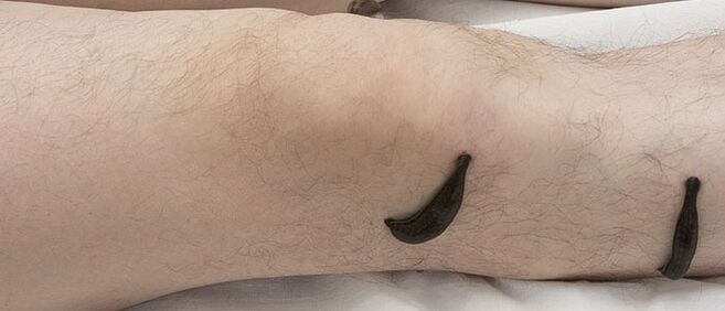 Хирудотерапия